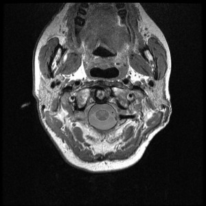 MRI scan showing fat infiltration into neck muscle 
