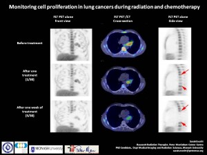 Monitoring cell proliferation in lung cancers during radiation and chemotherapy. Credit: Sarah Everitt, Peter MacCallum Cancer Centre