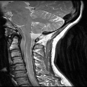 MRI scan showing fat infiltration into neck muscle 